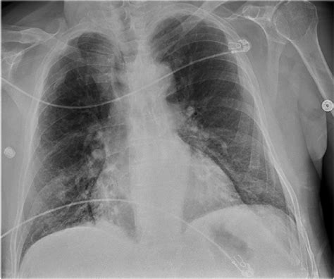 AP Chest Radiograph Obtained On Admission Depicting Moderate Perihilar