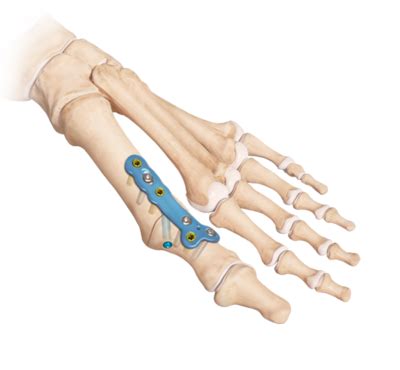 Arthrex - MTP Joint Arthrodesis