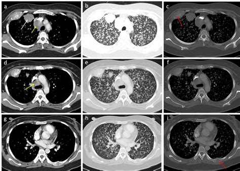 Lung Adenocarcinoma Radiology Cases