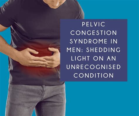 Pelvic Congestion Syndrome In Men