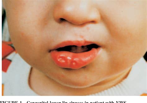 Figure 1 From Surgical Correction Of Congenital Lower Lip Sinuses In