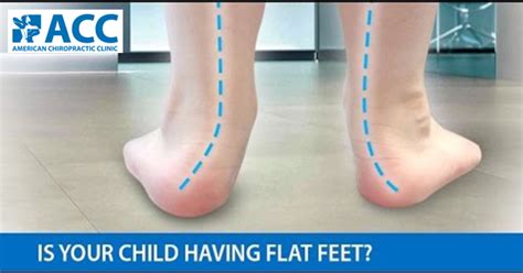 Flat Feet And Foot Pain Are Not Normal