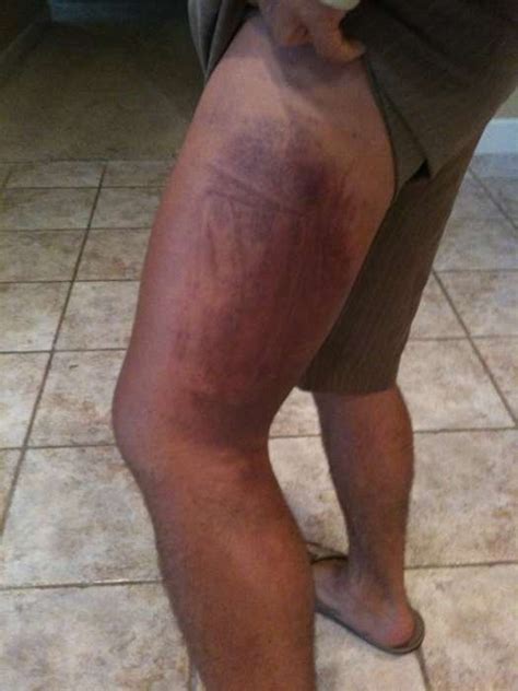 Urijah Faber S Leg After Fighting Jose Aldo At Wec Mma Fighters