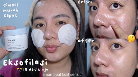 Eksfoliasi 15 Detik Aman Untuk Kulit Sensitif Review Focalskin Safely