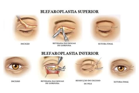 Blefaroplastia Instituto Corpory