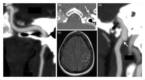 Imaging Findings In A 39 Year Old Woman With Post Partum Rcvs Download Scientific Diagram