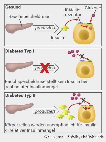 Diabetes Mellitus Ursachen Symptome Behandlung NetDoktor AT