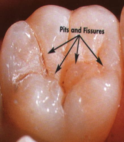 Lecture 2 Caries Diagnosis And Treatment Planning Direct Flashcards