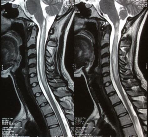 6 Neuromielitis Optica Irm Sagital Columna Cervical Ocronos