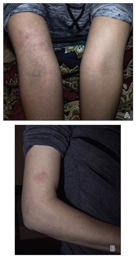 Cutaneous Filariasis in an American Traveler | MDedge Dermatology