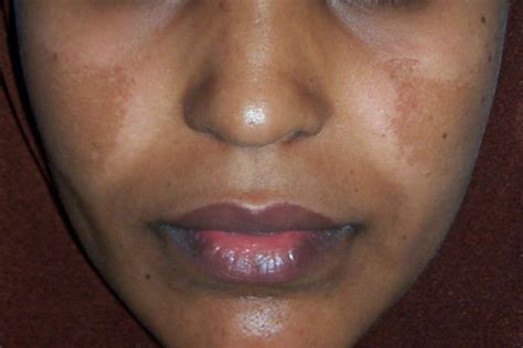 Hyperpigmentation Skin Triggers Effects And Treatments