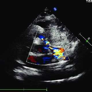 cw  rvot showing  gradient   mmhg rvot  ventricular