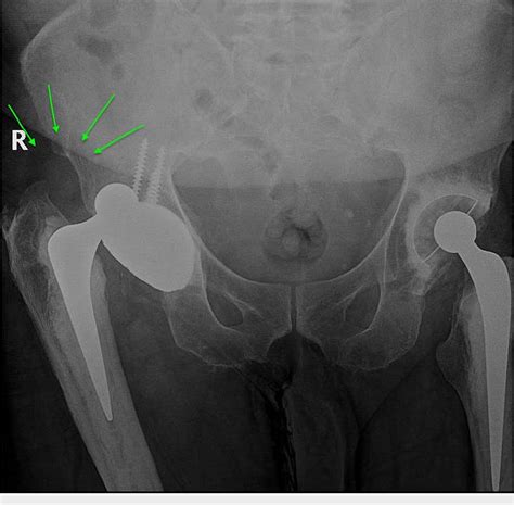 Figure 2 From Intraprosthetic Dislocation Of Dual Mobility Total Hip Arthroplasty The