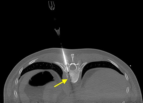 Image Guided Biopsy Radiology At St Vincents University Hospital