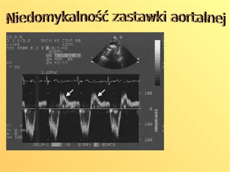 Wady Niedomykalno Zastawki Aortalnej