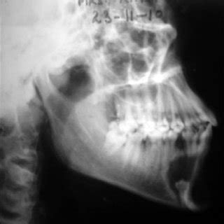 Lateral oblique radiograph showing well-defined unilocular radiolucency ...