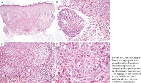 Pdf Congenital Self Healing Reticulohistiocytosis In A Newborn