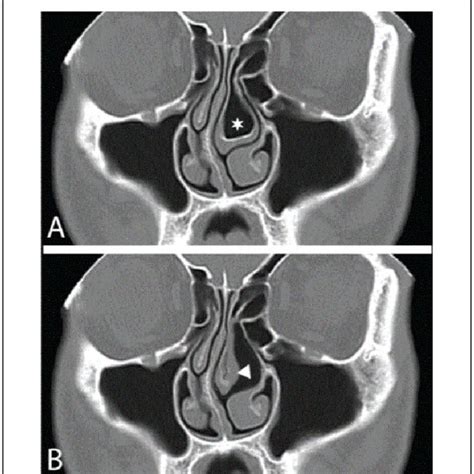 Pdf A Simple Minimally Invasive Technique To Reduce The Size Of