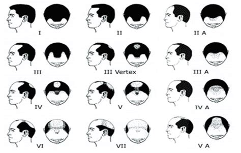 Hereditary Baldness The Venkat Center For Hair Transplant