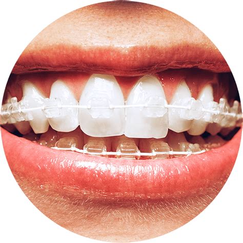 Six Month Smiles Guided Orthodontics For The General Dentist