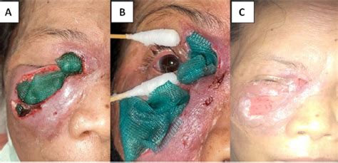 Figure 1 From Management Of Orbital Cellulitis With Periorbital Abscess