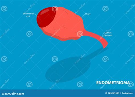 D Ilustraci N Conceptual Vectorial Plana Isom Trica Del Endometrioma