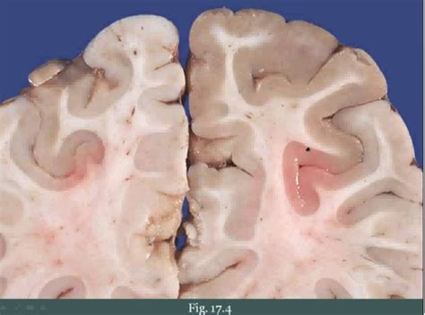 17 4 Cerebrovascular Disease Flashcards Quizlet