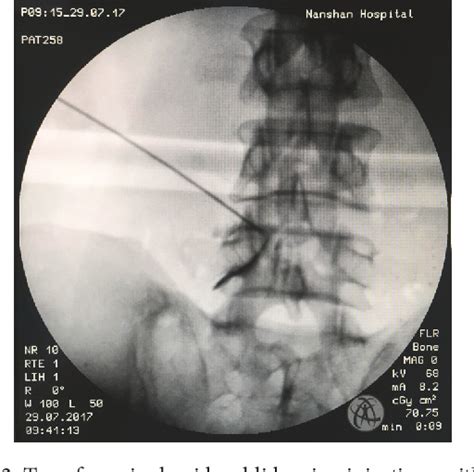 Figure From Transforaminal Percutaneous Endoscopic Lumbar