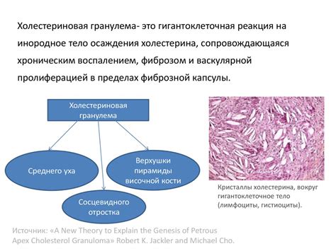 Холестериновая гранулема - online presentation