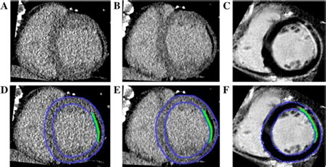 Assessment Of Myocardial Viability Based On Dual Energy Computed