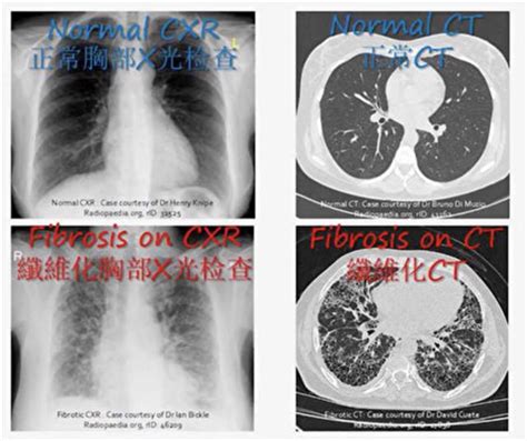 每13分鐘有1人死於這種病 醫：和癌症一樣重視 檢測 治療 特發性肺纖維化 大紀元