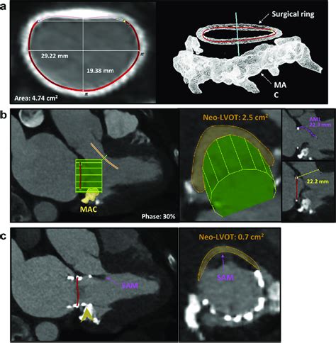 Valve-in-ring MDCT planning and complications. (a) Internal dimensions ...