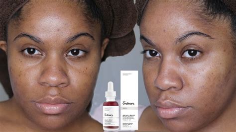 Diy Chemial Peel The Ordinary Aha 30 Bha 2 Peeling Solution Review Youtube