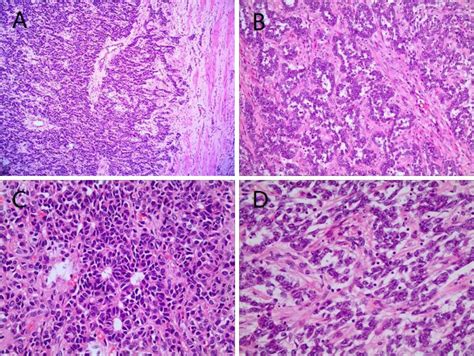 Clinicopathological Characteristics And Genetic Variations Of Uterine