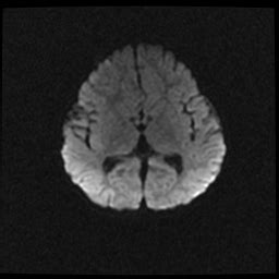 Septo Optic Dysplasia Image Radiopaedia Org