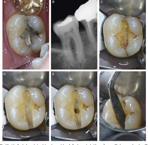 Pdf Longitudinal Tooth Fractures Findings That Contribute To Complex