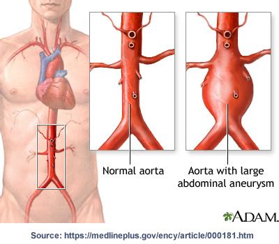 WHAT IS ENDOVASCULAR STENT GRAFTING?