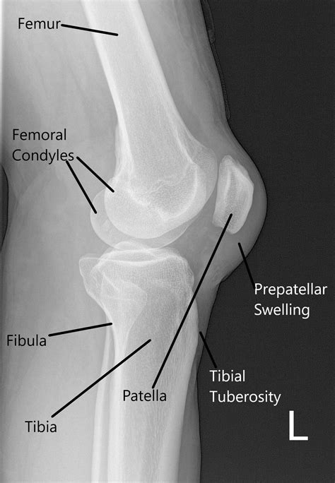 Lateral Knee Anatomy Ultrasound