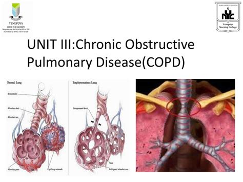 Ppt Unit Iiichronic Obstructive Pulmonary Diseasecopd Powerpoint Presentation Id234124