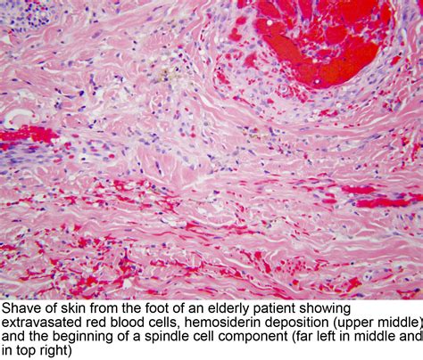 Pathology Outlines Kaposi Sarcoma