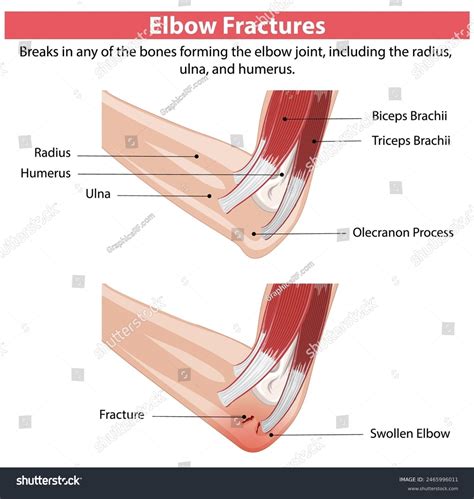 Detailed Diagram Elbow Fractures Stock Vector (Royalty Free) 2465996011