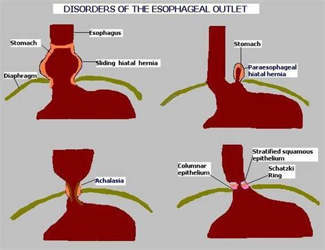 ESOPHAGUS Achalasia Pathology Medical Knowledge Gastrointestinal