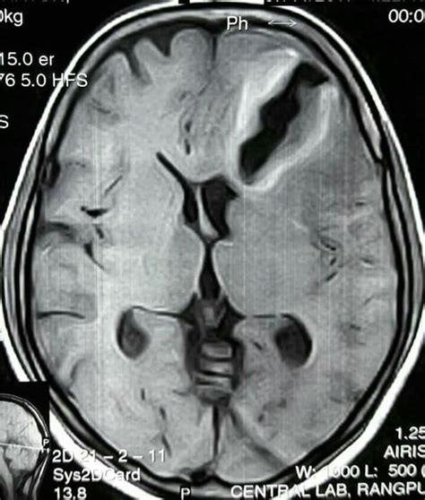 Gliosis Mri - IMobile Cool