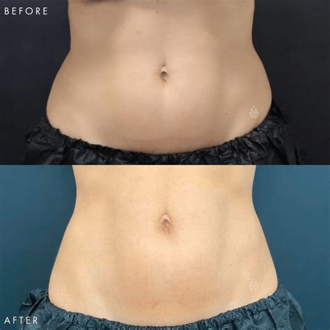 Las Vegas CoolSculpting Treatment Before After Pictures Sculpt Spa