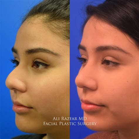 Hispanic Rhinoplasty Orange County Hispanic Nose Job Newport Beach