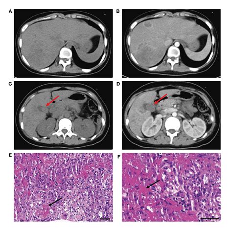 Figure 1 From Antiphospholipid Antibody Related Hepatic Vasculitis In A