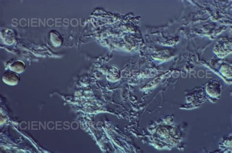 Photograph Pneumocystis Jirovecii Spores In Lung Science Source Images