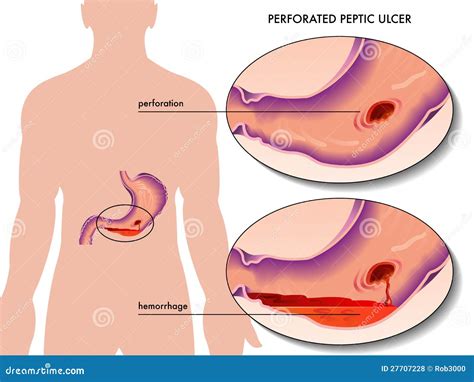 Perforated Duodenal Ulcer