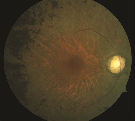 Understanding Usher Syndrome New Findings Research To Prevent Blindness