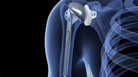 Physical Therapy For Total Shoulder Replacement A Guide To Recovery